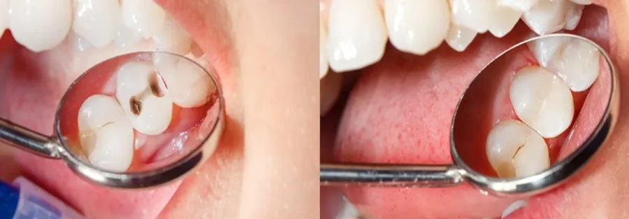 پوسیدگی دندان بعد از کامپوزیت