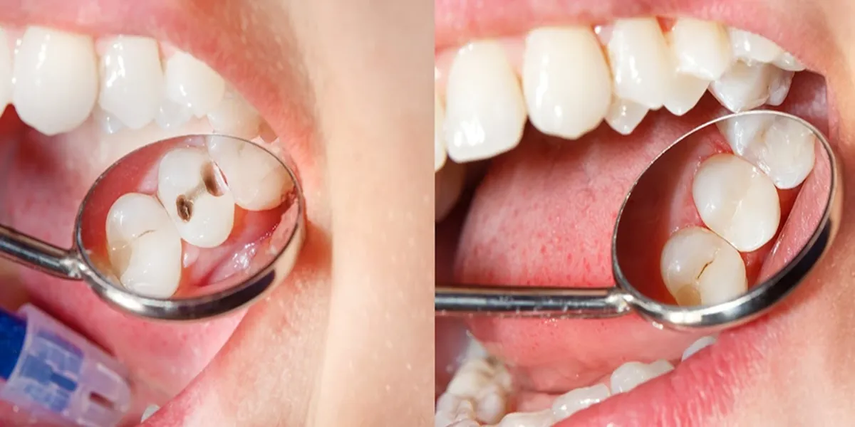 پوسیدگی دندان بعد از کامپوزیت