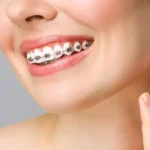 بهترین انتخاب بین ارتودنسی و کامپوزیت برای دندان های نامرتب