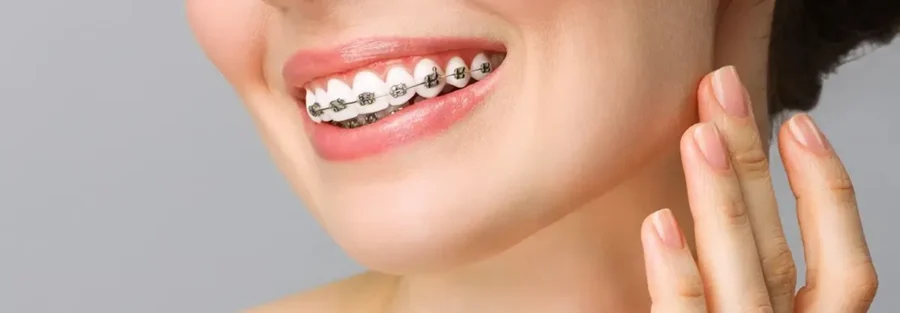 ارتودنسی یا کامپوزیت