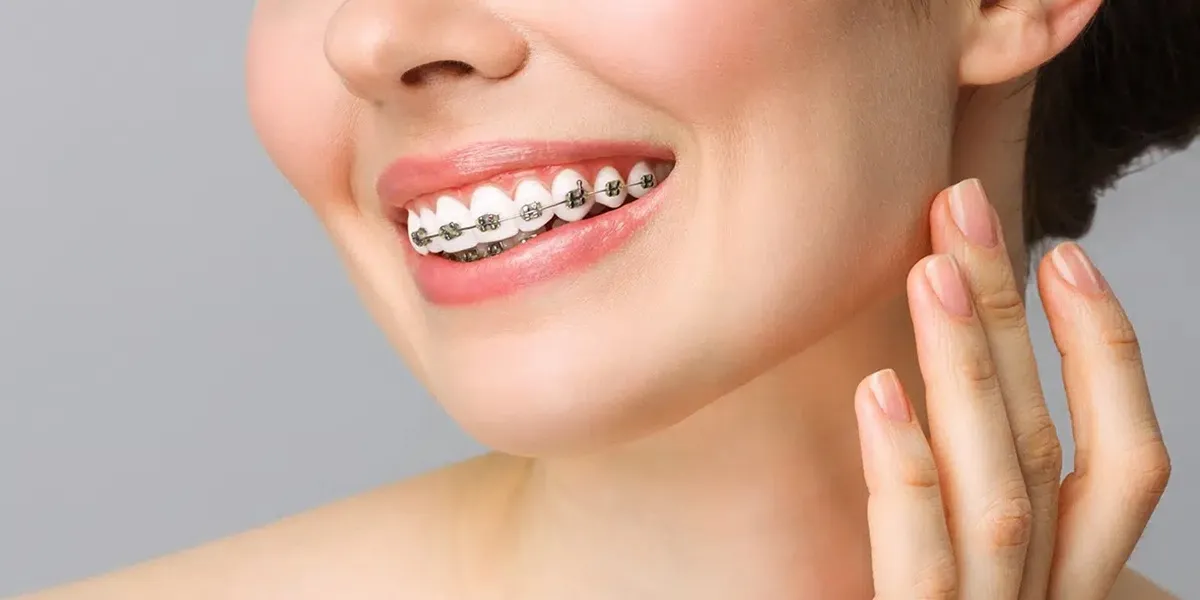 ارتودنسی یا کامپوزیت