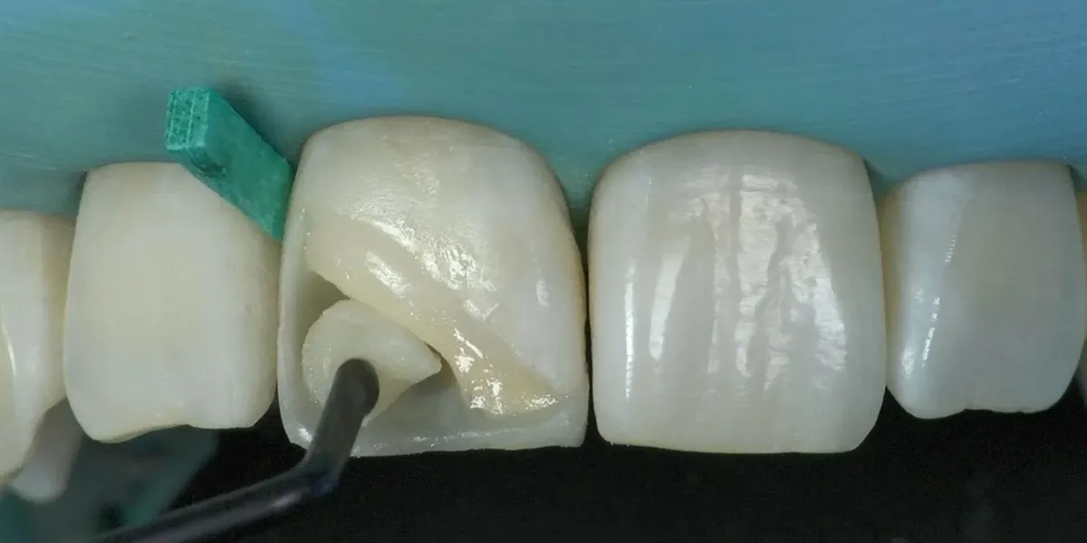 طول عمر کامپوزیت دندان