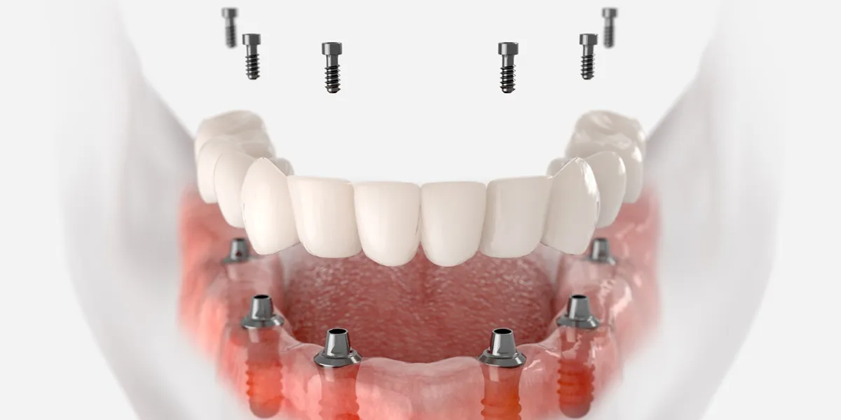 برندهای هیلینگ ایمپلنت