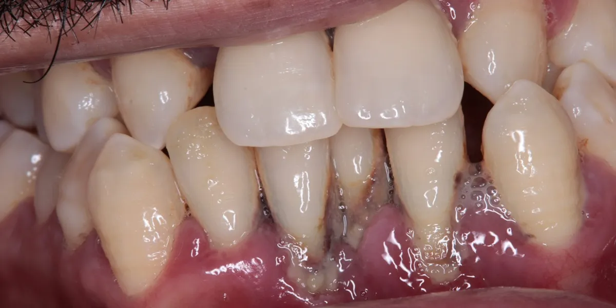 التهاب لثه بعد از کامپوزیت