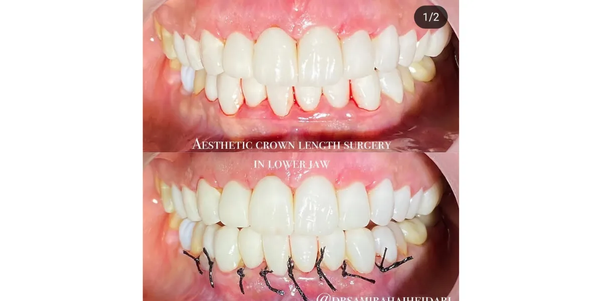 دوران نقاهت جراحی لثه چقدر است و چگونه سریع‌تر بهبود یابیم؟