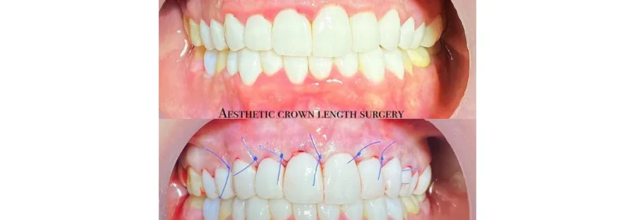 دوران نقاهت جراحی لثه