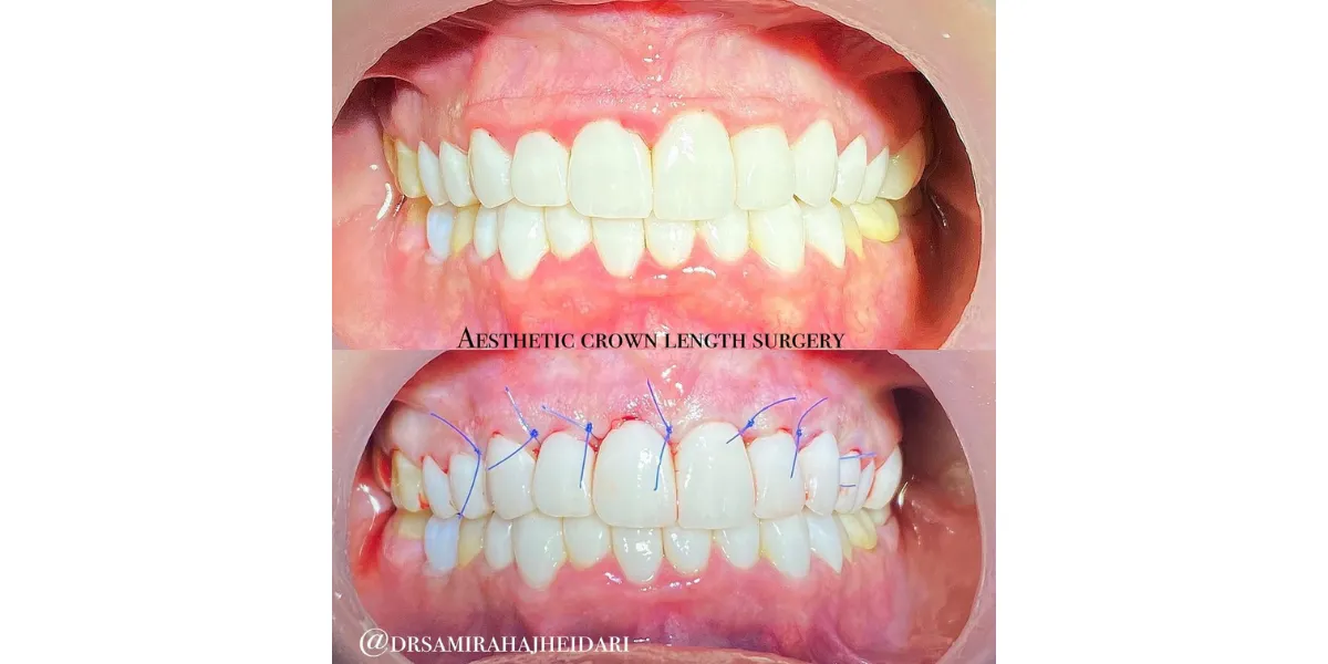 دوران نقاهت جراحی لثه