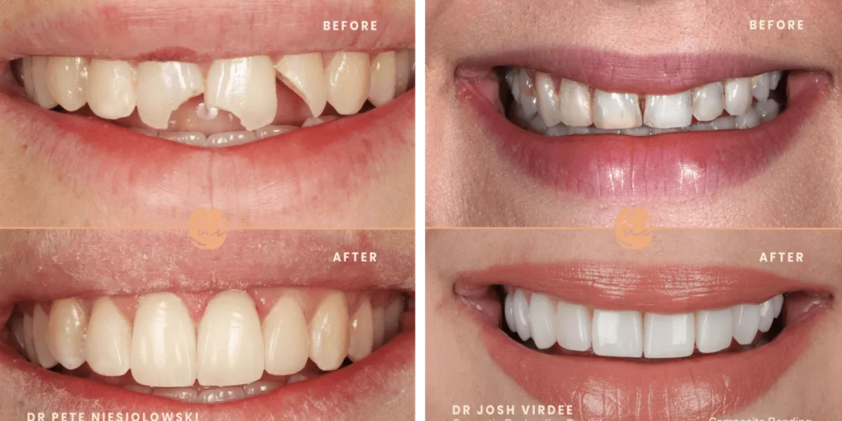 باندینگ دندان چیست و چه تفاوتی با کامپوزیت دارد؟