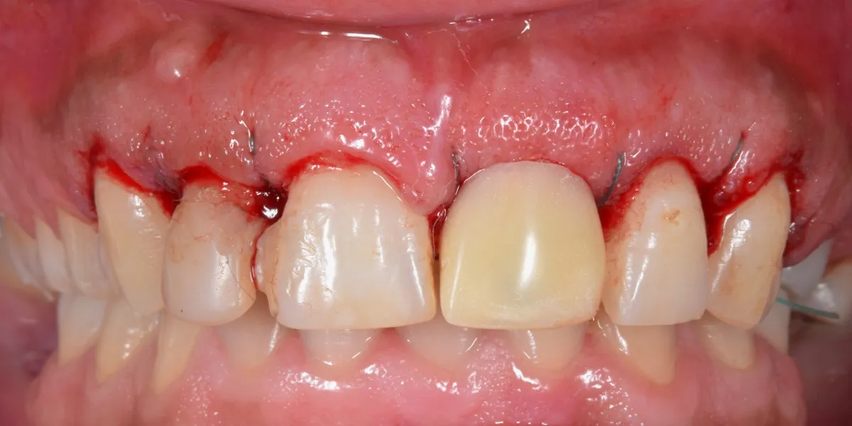 التهاب لثه بعد از کامپوزیت