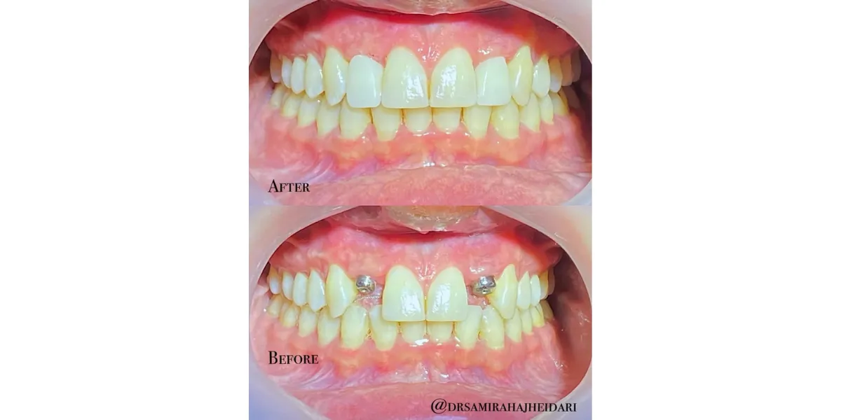 بهترین متخصص های ایمپلنت فوری در کرج