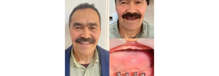 بهترین متخصص های ایمپلنت فوری در کرج