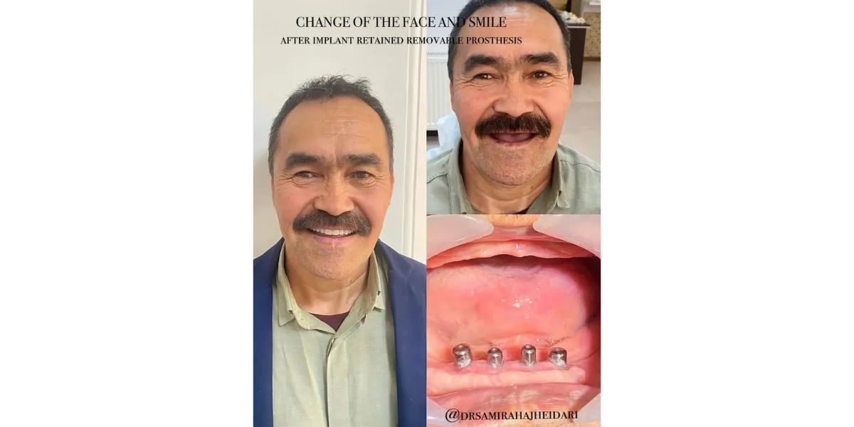 بهترین متخصص های ایمپلنت فوری در کرج