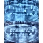 اسکنر داخل دهانی در کامپوزیت و ایمپلنت؛ مزایا و دقت