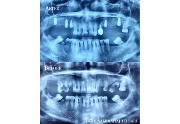 اسکنر داخل دهانی در کامپوزیت و ایمپلنت