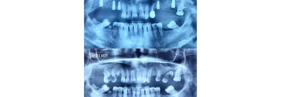 اسکنر داخل دهانی در کامپوزیت و ایمپلنت