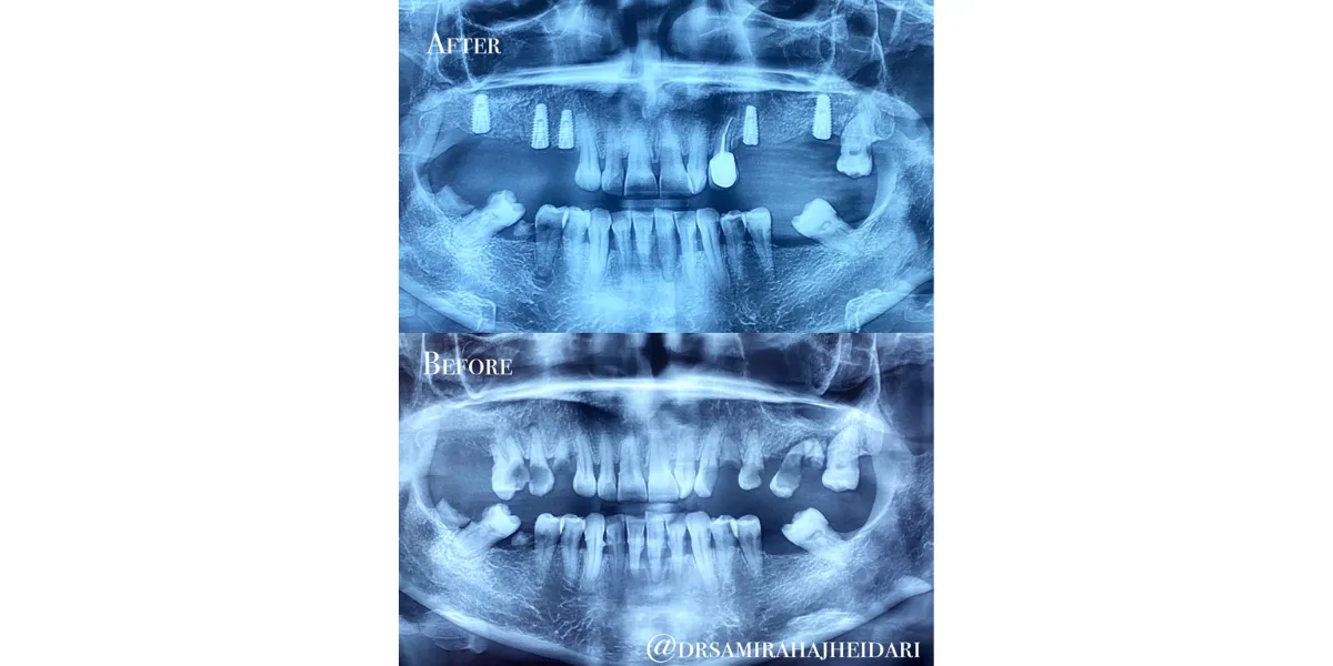 اسکنر داخل دهانی در کامپوزیت و ایمپلنت