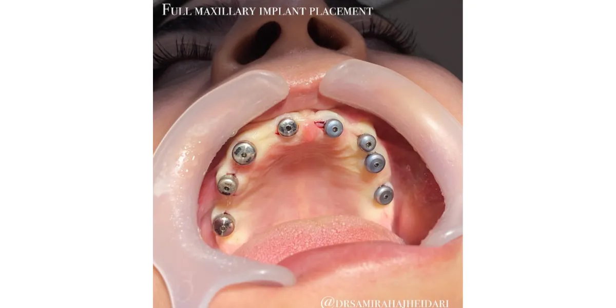 هزینه ایمپلنت قسطی در تهران