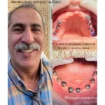 هزینه ایمپلنت قسطی در تهران؛ شرایط، مدارک و مدت بازپرداخت