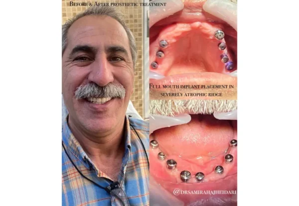 هزینه ایمپلنت قسطی در تهران