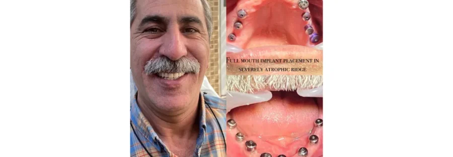 هزینه ایمپلنت قسطی در تهران