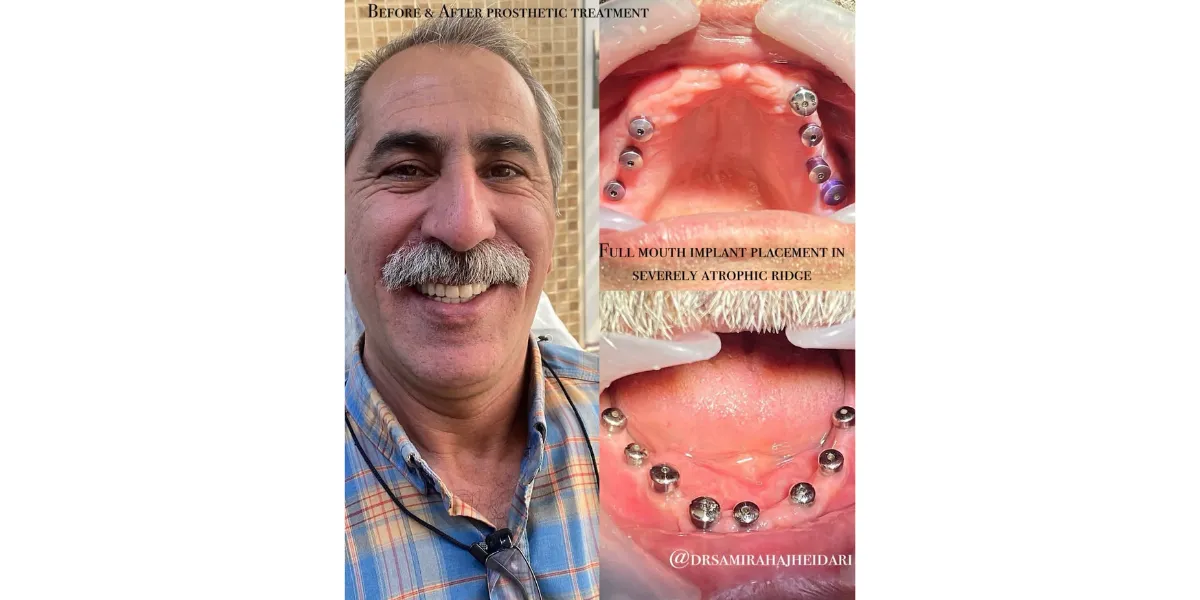 بهترین ایمپلنتولوژیست های اصلی در کرج