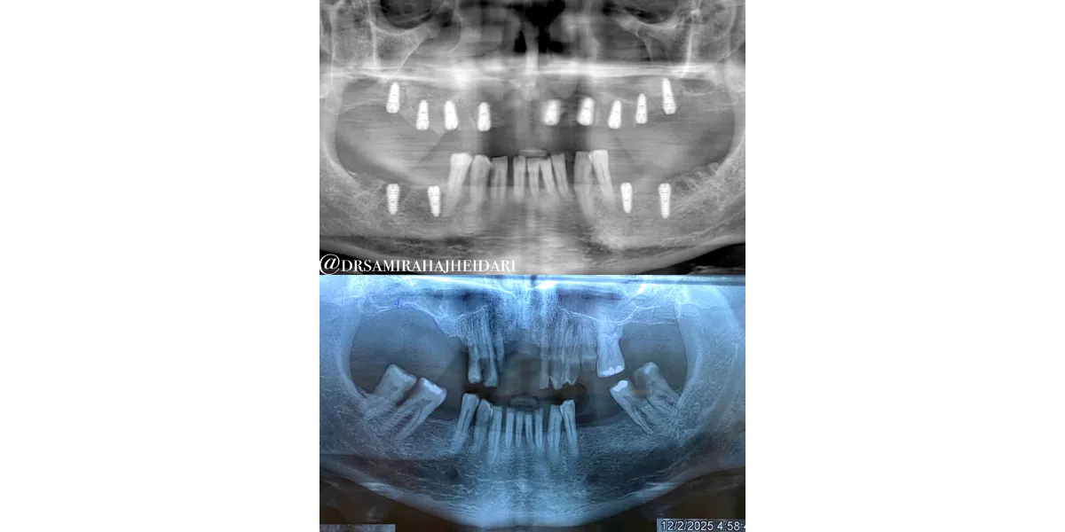 اسکنر داخل دهانی در کامپوزیت و ایمپلنت