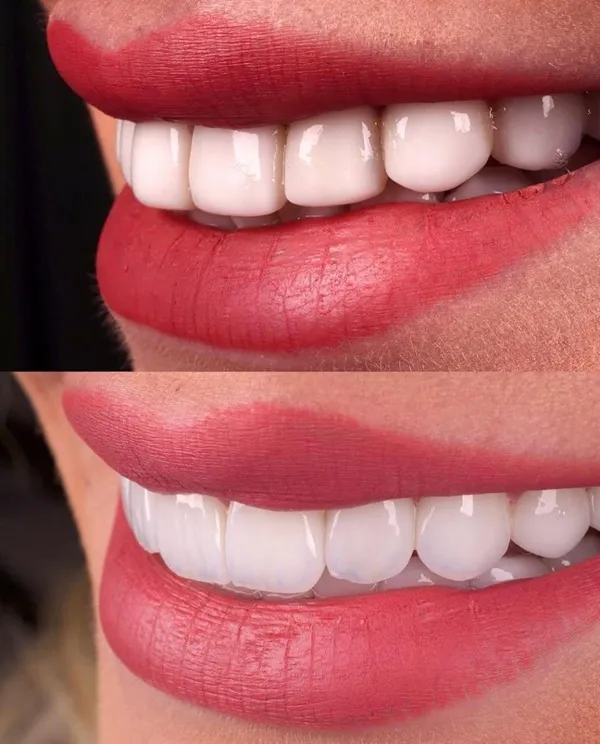 خط لبخند چیست و چگونه در طراحی کامپوزیت تأثیر دارد؟