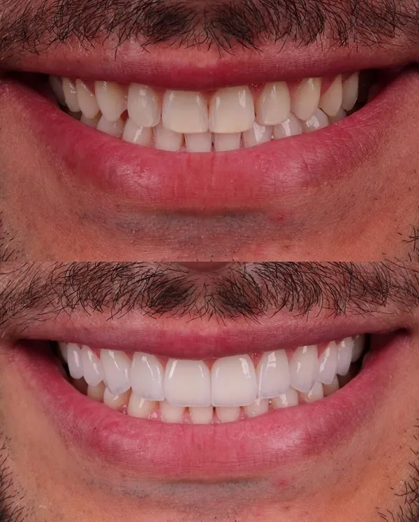 طراحی خط لبخند